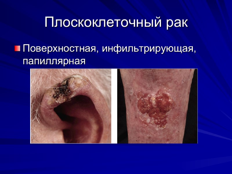 Плоскоклеточный рак  Поверхностная, инфильтрирующая, папиллярная